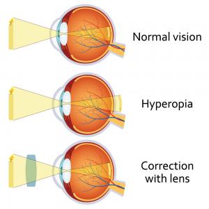 Hyperopia (Long-Sighted) | Aphrodite Livanes Optometrist Brisbane: Eye ...