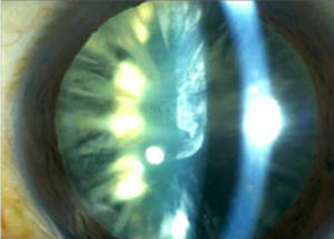 Age Related Cataracts